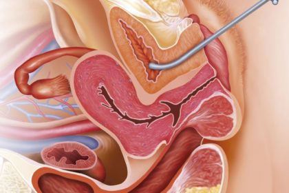 Dr. Felipe Ladeira Fístulas Urinárias