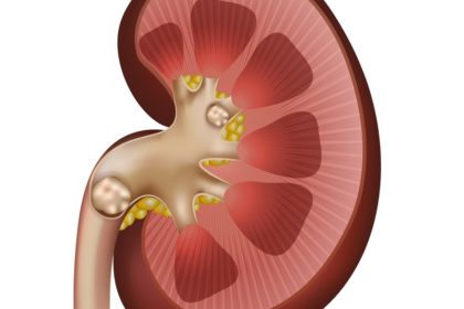 Dr. Felipe Ladeira mitos sobre cálculo renal
